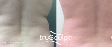 truSculpt_Body_11