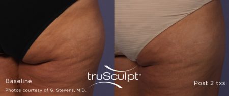 truSculpt_Body_5